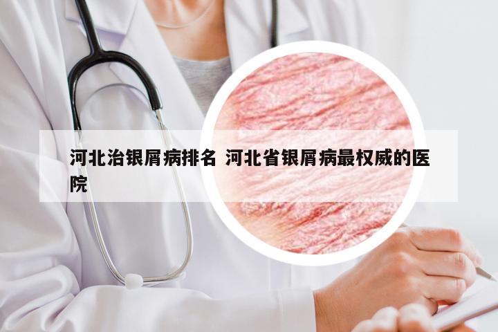 河北治银屑病排名 河北省银屑病最权威的医院