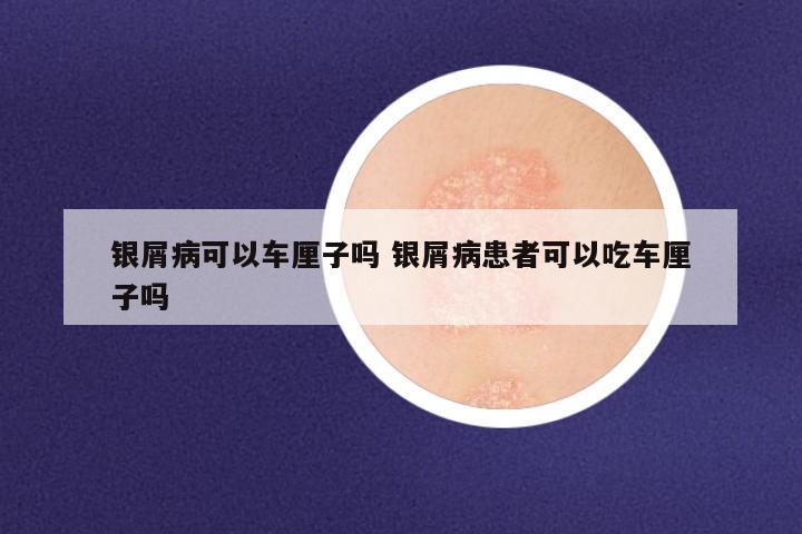 银屑病可以车厘子吗 银屑病患者可以吃车厘子吗