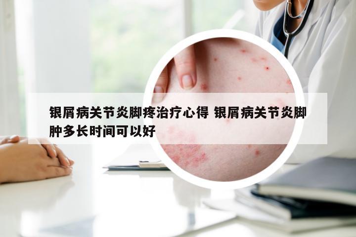 银屑病关节炎脚疼治疗心得 银屑病关节炎脚肿多长时间可以好