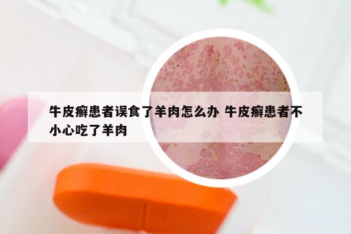 牛皮癣患者误食了羊肉怎么办 牛皮癣患者不小心吃了羊肉