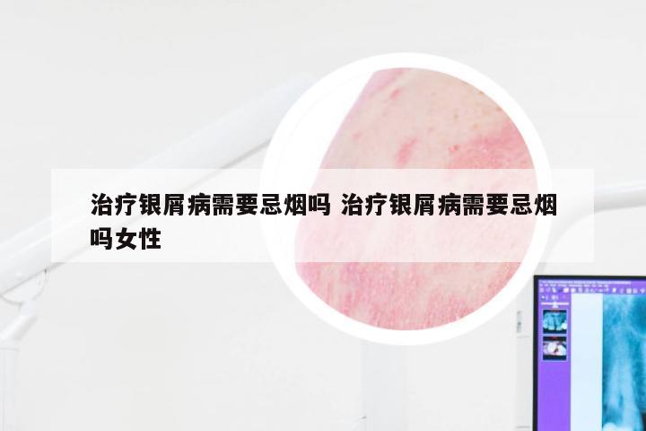 治疗银屑病需要忌烟吗 治疗银屑病需要忌烟吗女性