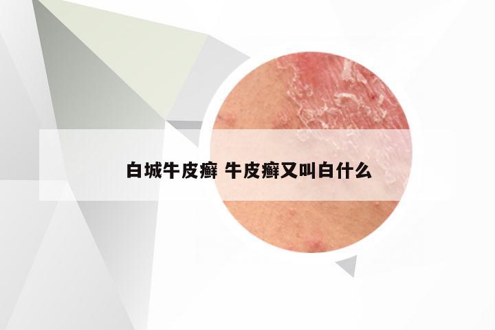 白城牛皮癣 牛皮癣又叫白什么