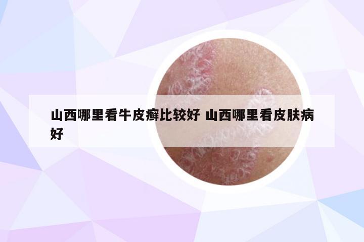 山西哪里看牛皮癣比较好 山西哪里看皮肤病好