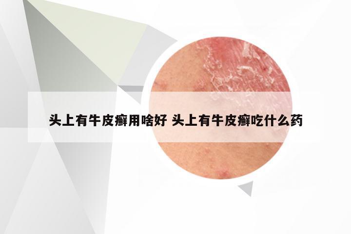 头上有牛皮癣用啥好 头上有牛皮癣吃什么药