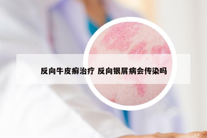 反向牛皮癣治疗 反向银屑病会传染吗