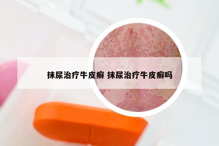 抹尿治疗牛皮癣 抹尿治疗牛皮癣吗