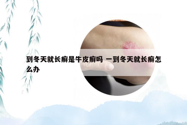 到冬天就长癣是牛皮癣吗 一到冬天就长癣怎么办