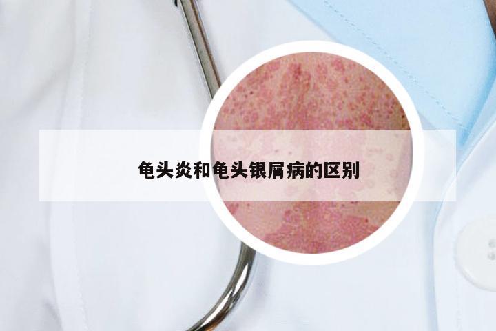 龟头炎和龟头银屑病的区别
