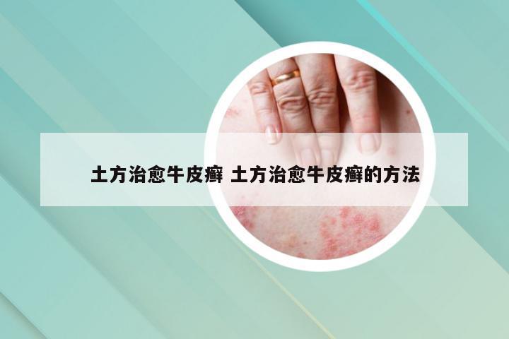 土方治愈牛皮癣 土方治愈牛皮癣的方法