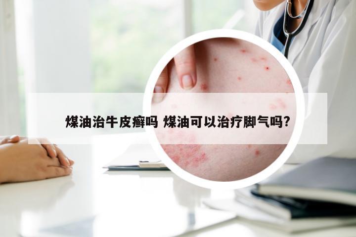 煤油治牛皮癣吗 煤油可以治疗脚气吗?
