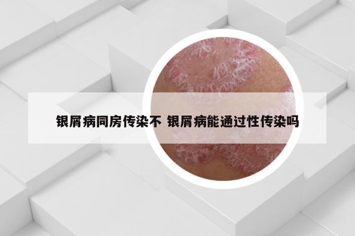 银屑病同房传染不 银屑病能通过性传染吗