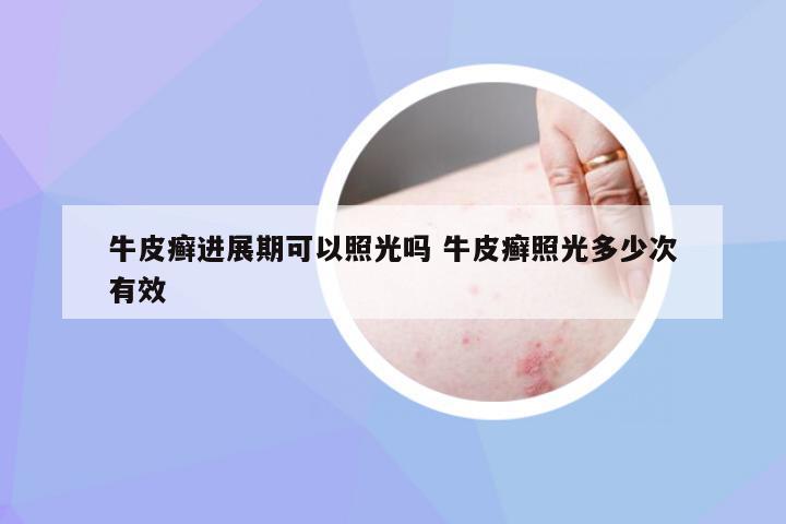 牛皮癣进展期可以照光吗 牛皮癣照光多少次有效