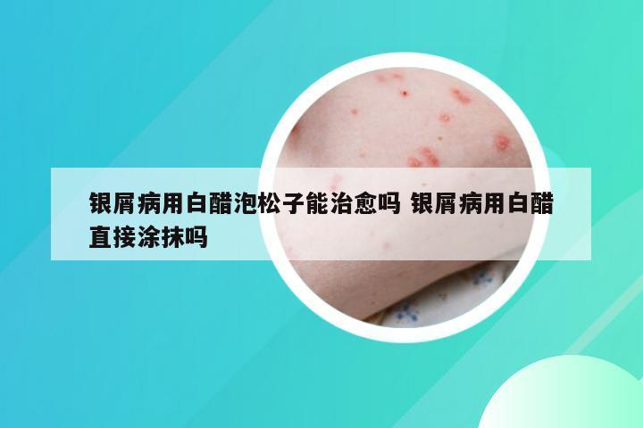银屑病用白醋泡松子能治愈吗 银屑病用白醋直接涂抹吗