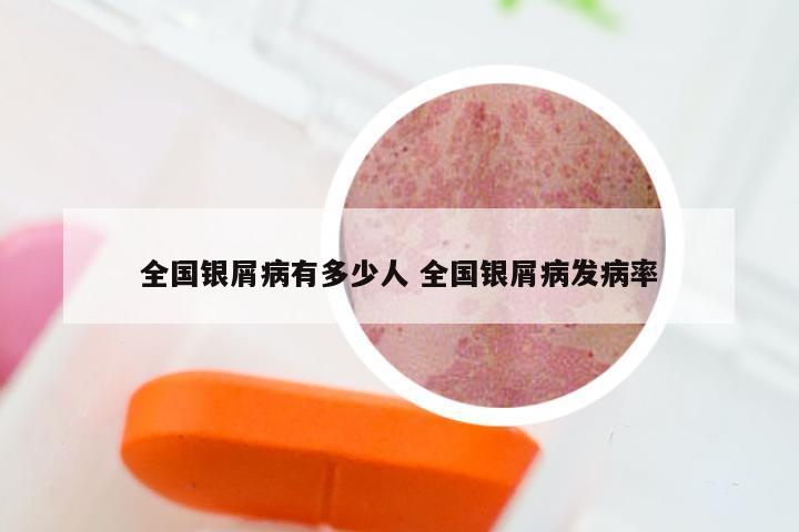 全国银屑病有多少人 全国银屑病发病率