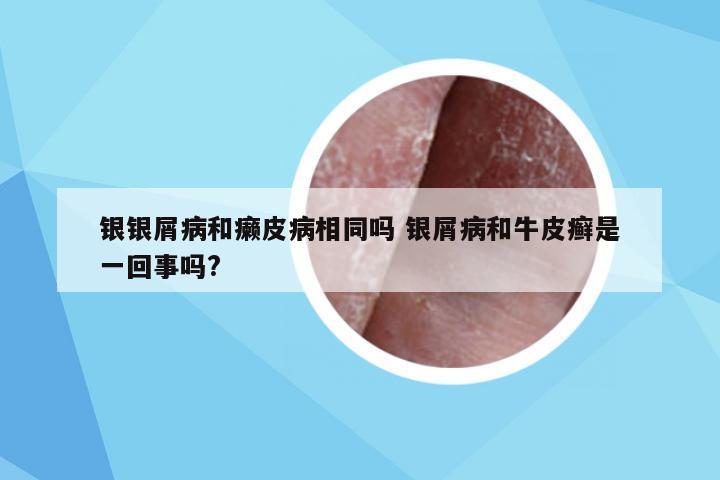 银银屑病和癞皮病相同吗 银屑病和牛皮癣是一回事吗?