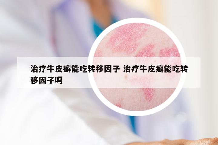 治疗牛皮癣能吃转移因子 治疗牛皮癣能吃转移因子吗