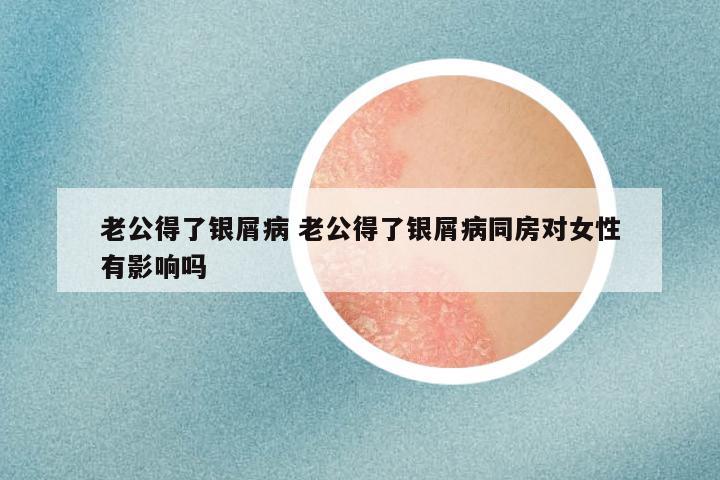 老公得了银屑病 老公得了银屑病同房对女性有影响吗