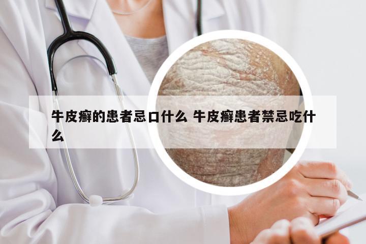 牛皮癣的患者忌口什么 牛皮癣患者禁忌吃什么