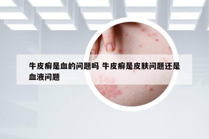 牛皮癣是血的问题吗 牛皮癣是皮肤问题还是血液问题