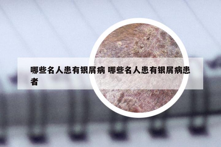 哪些名人患有银屑病 哪些名人患有银屑病患者