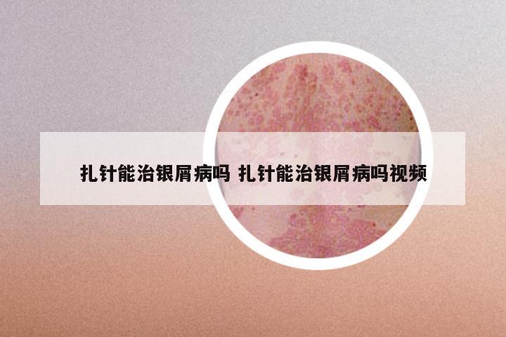 扎针能治银屑病吗 扎针能治银屑病吗视频