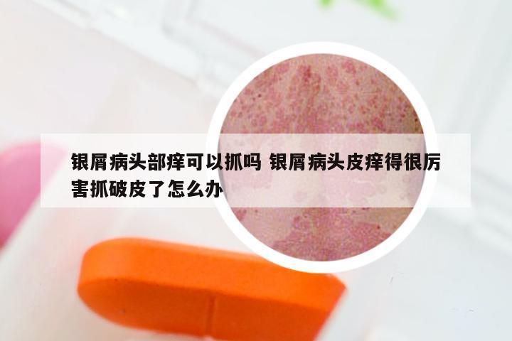 银屑病头部痒可以抓吗 银屑病头皮痒得很厉害抓破皮了怎么办