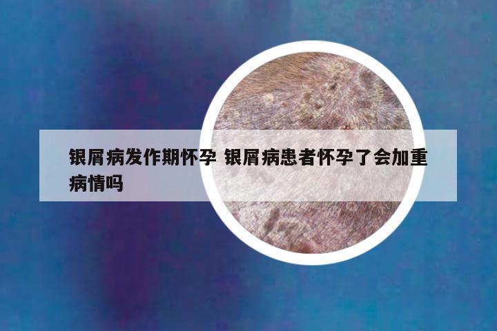 银屑病发作期怀孕 银屑病患者怀孕了会加重病情吗
