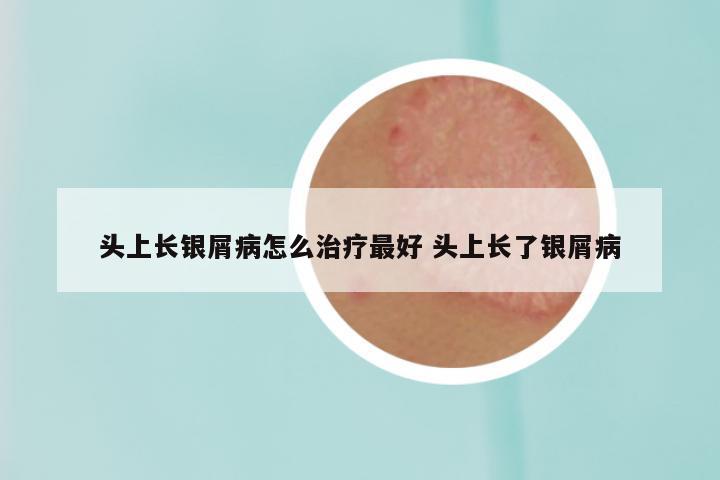 头上长银屑病怎么治疗最好 头上长了银屑病