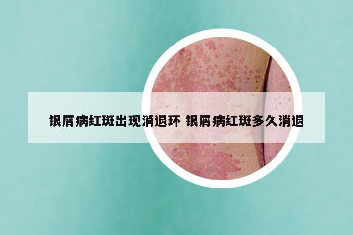 银屑病红斑出现消退环 银屑病红斑多久消退