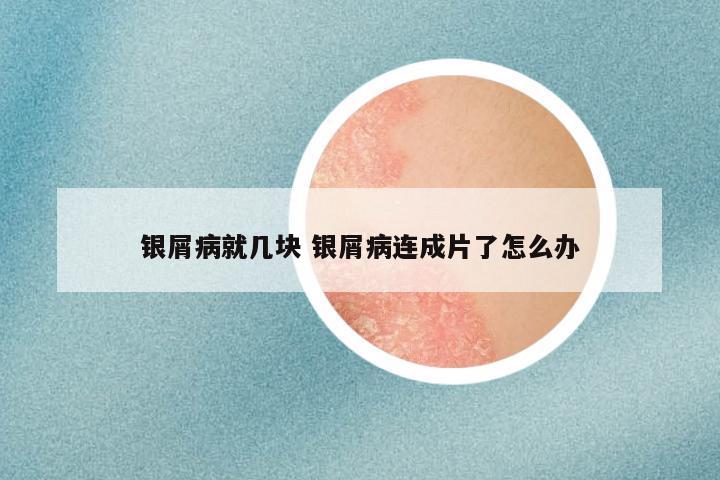 银屑病就几块 银屑病连成片了怎么办