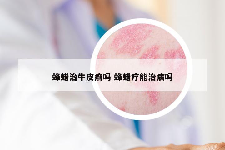 蜂蜡治牛皮癣吗 蜂蜡疗能治病吗