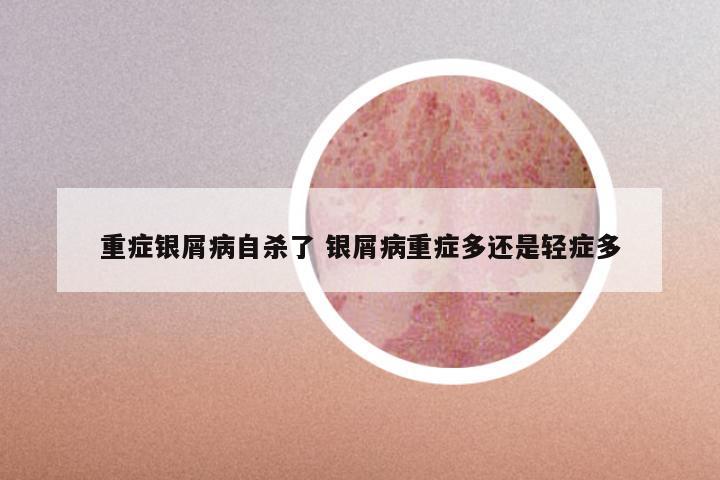 重症银屑病自杀了 银屑病重症多还是轻症多