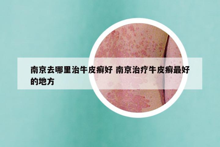 南京去哪里治牛皮癣好 南京治疗牛皮癣最好的地方