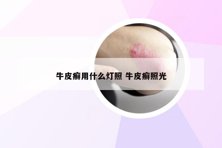 牛皮癣用什么灯照 牛皮癣照光