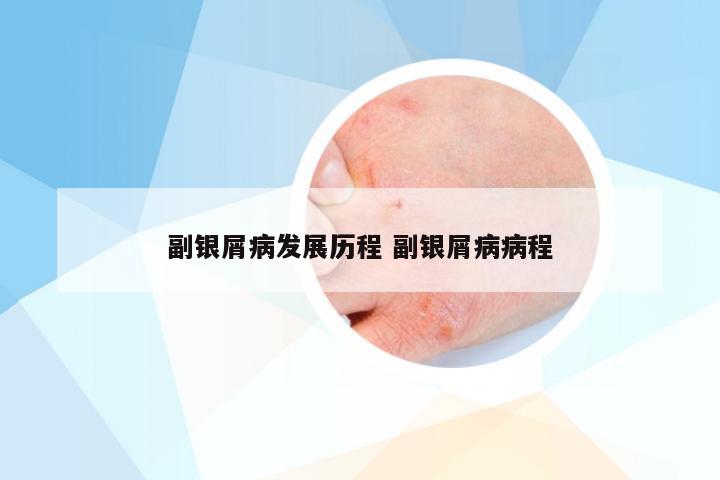 副银屑病发展历程 副银屑病病程