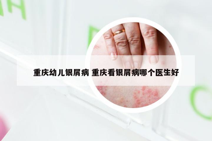重庆幼儿银屑病 重庆看银屑病哪个医生好