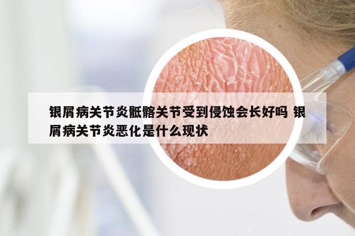 银屑病关节炎骶髂关节受到侵蚀会长好吗 银屑病关节炎恶化是什么现状