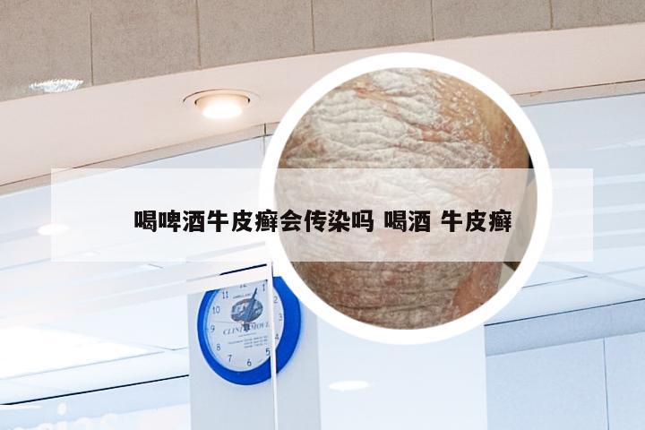 喝啤酒牛皮癣会传染吗 喝酒 牛皮癣