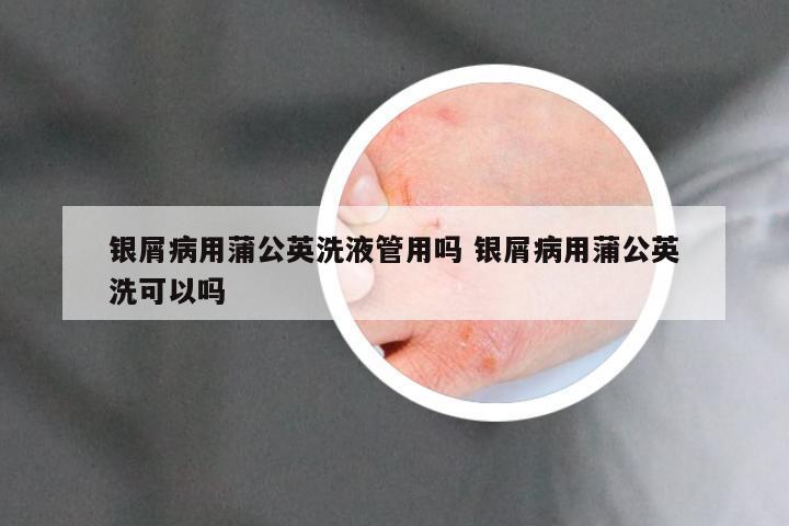银屑病用蒲公英洗液管用吗 银屑病用蒲公英洗可以吗