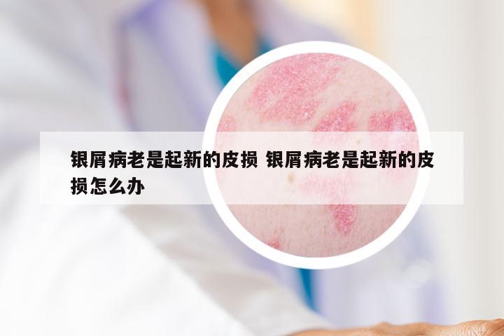 银屑病老是起新的皮损 银屑病老是起新的皮损怎么办