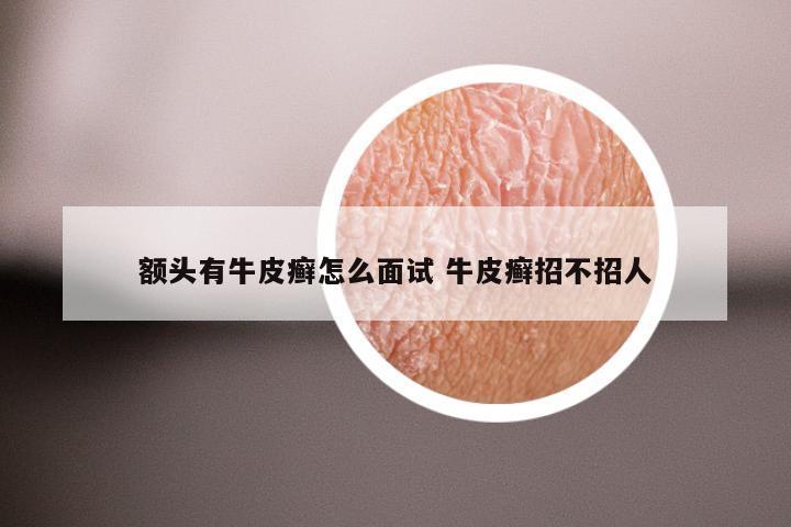 额头有牛皮癣怎么面试 牛皮癣招不招人