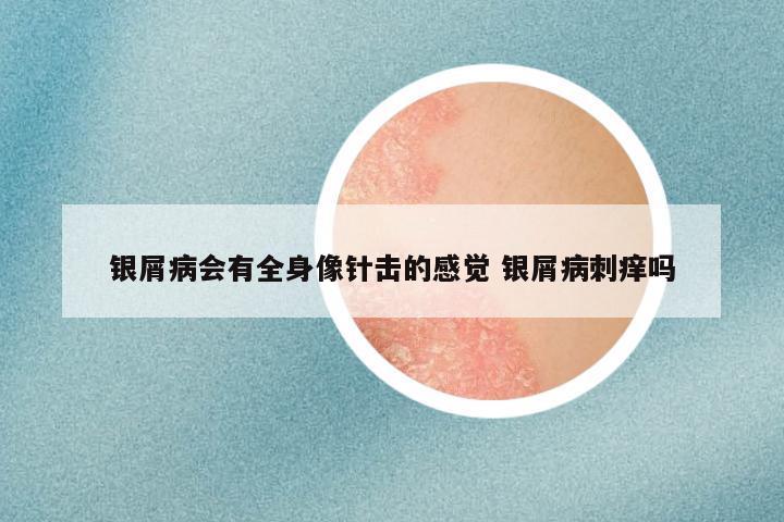 银屑病会有全身像针击的感觉 银屑病刺痒吗