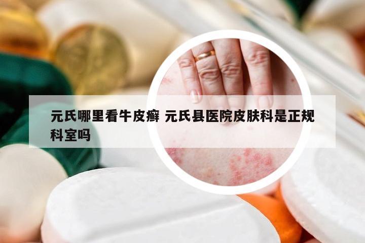 元氏哪里看牛皮癣 元氏县医院皮肤科是正规科室吗