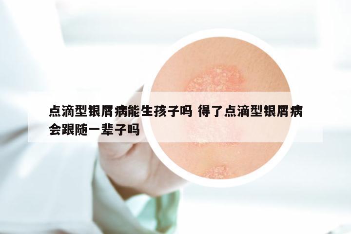 点滴型银屑病能生孩子吗 得了点滴型银屑病会跟随一辈子吗