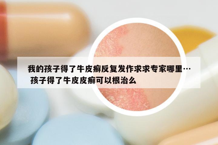 我的孩子得了牛皮癣反复发作求求专家哪里… 孩子得了牛皮皮癣可以根治么