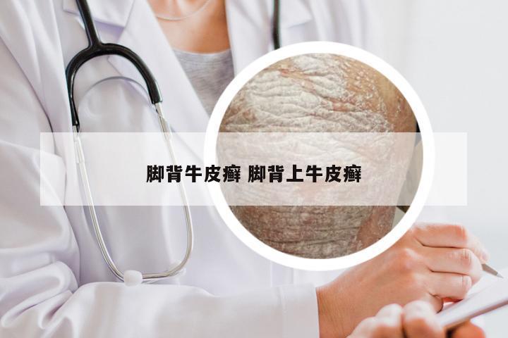 脚背牛皮癣 脚背上牛皮癣