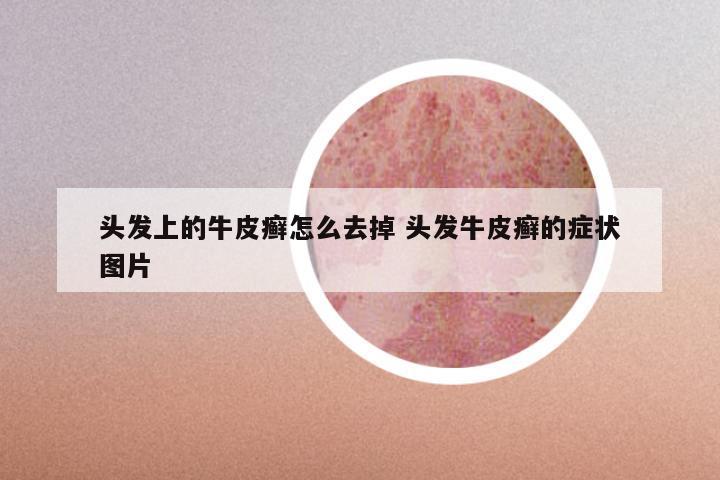 头发上的牛皮癣怎么去掉 头发牛皮癣的症状图片