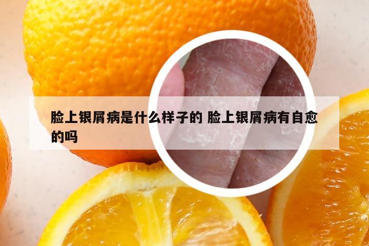 脸上银屑病是什么样子的 脸上银屑病有自愈的吗