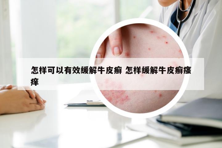 怎样可以有效缓解牛皮癣 怎样缓解牛皮癣瘙痒