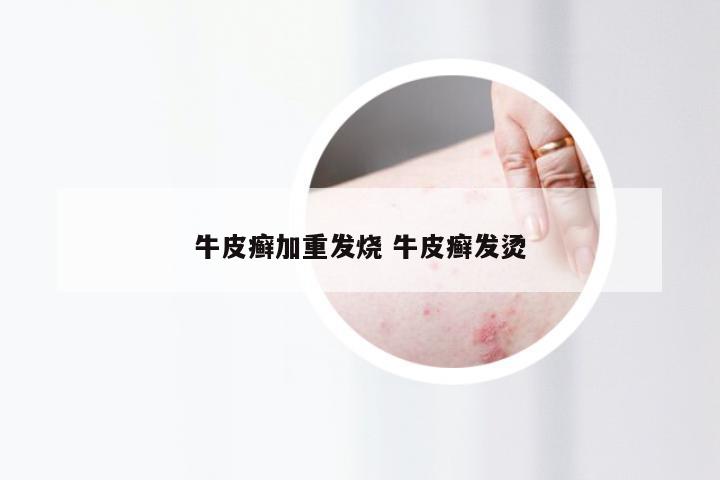 牛皮癣加重发烧 牛皮癣发烫